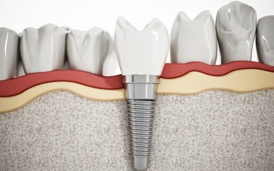 Dental Implants Oviedo: What You Should Know Before Getting Started