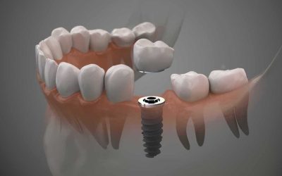 Periodontics and Dental Implants: The Connection