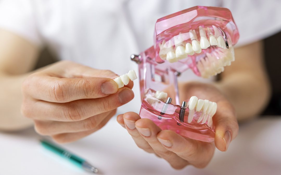 Dental Bridge vs. Implant: Which Lasts Longer?
