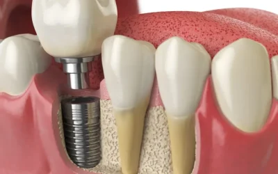 How Dental Implants Are Put In: Step-by-Step Guide