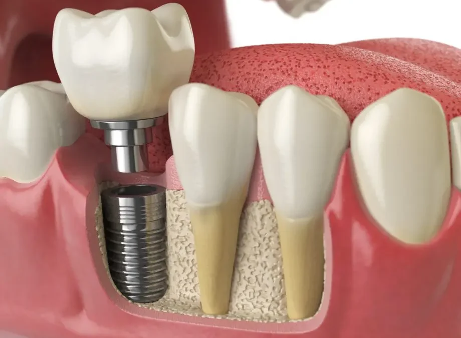 How Dental Implants Are Put In: Step-by-Step Guide