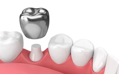 Dental Crown Maintenance Tips: Keeping Your Smile Strong