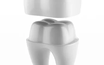 Dental Crown for Broken Tooth: Restoring Strength and Beauty
