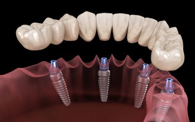 Different Types of Implant Dentures: Your Options