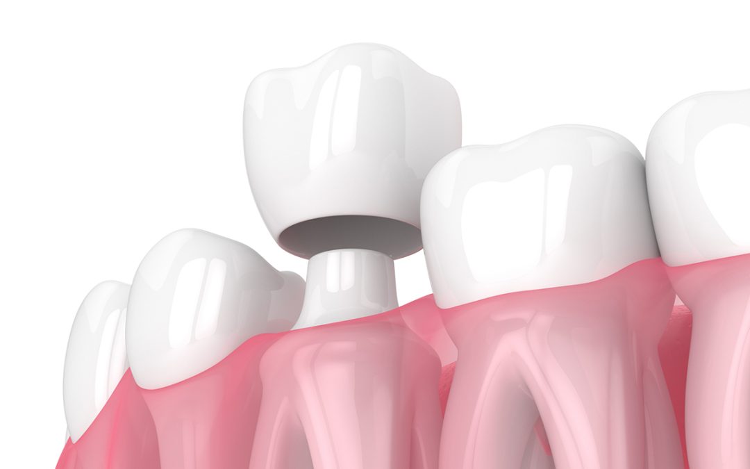 What Is a Dental Crown and When Is It Necessary?